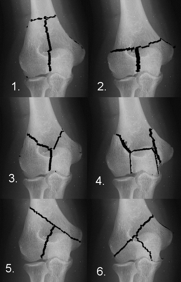 Distal Humeral fractures